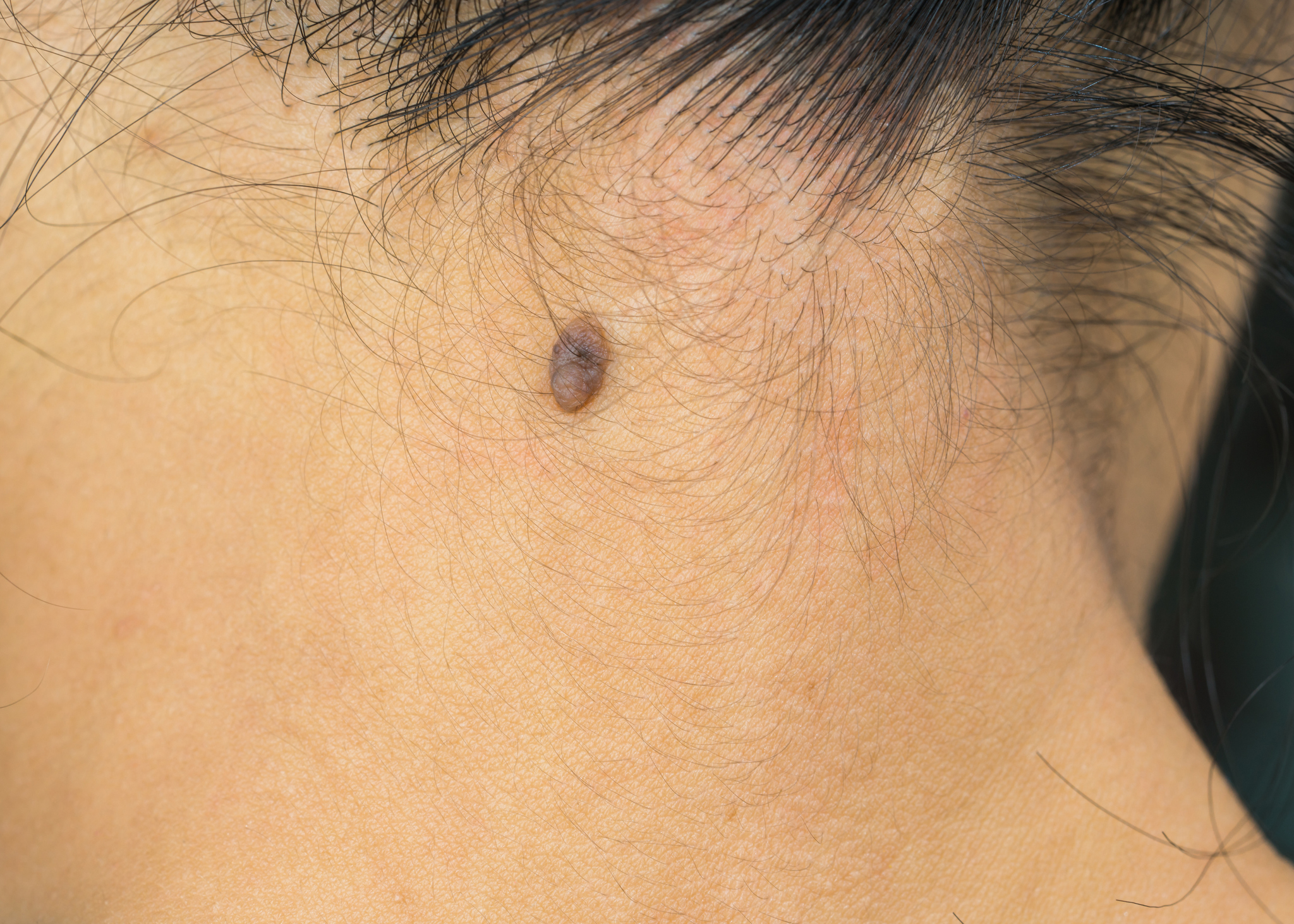 Black mole on the back neck skin of Asian woman need CO2 Laser to removal.