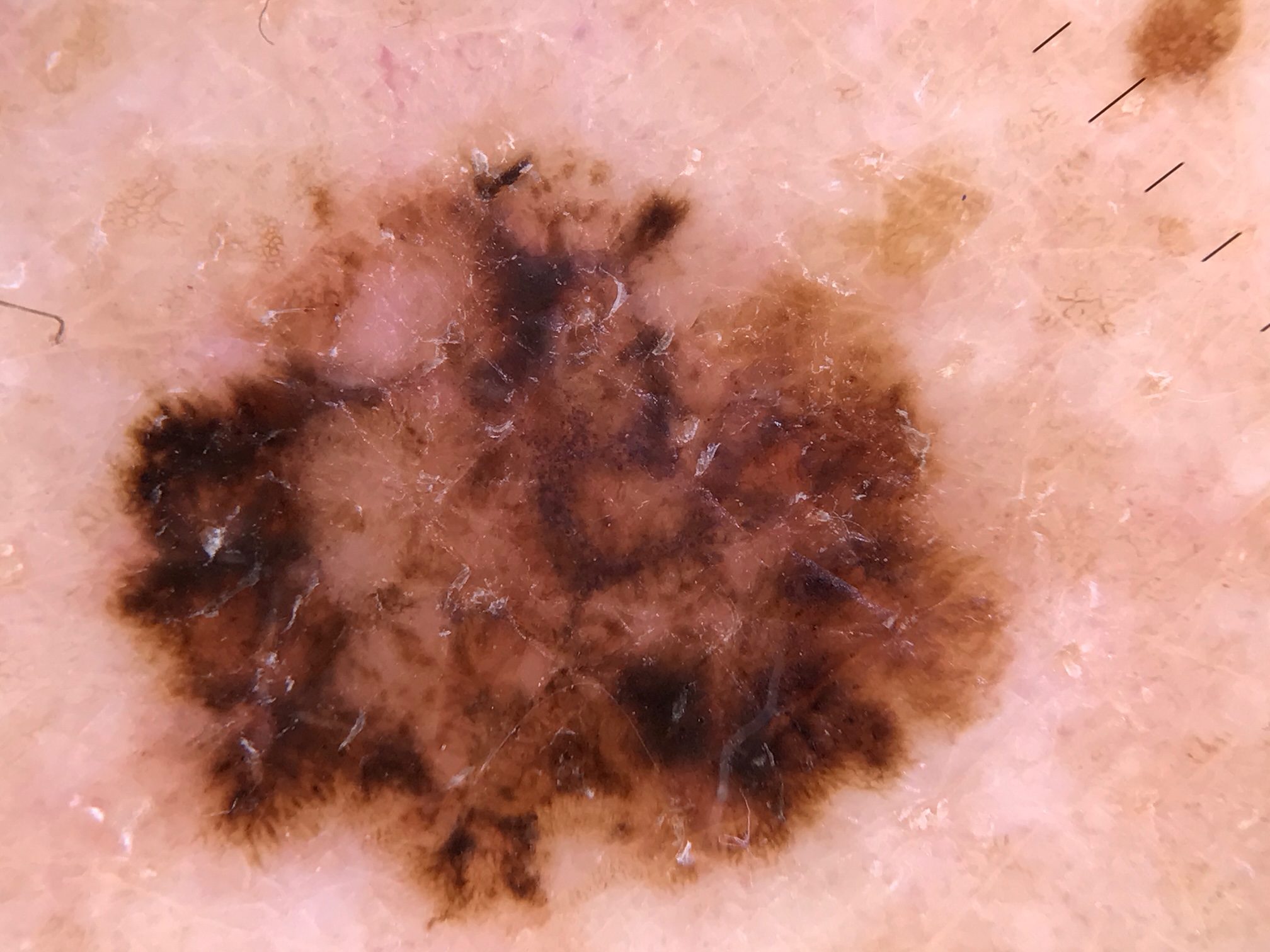 Skin Cancer Photos Melanoma