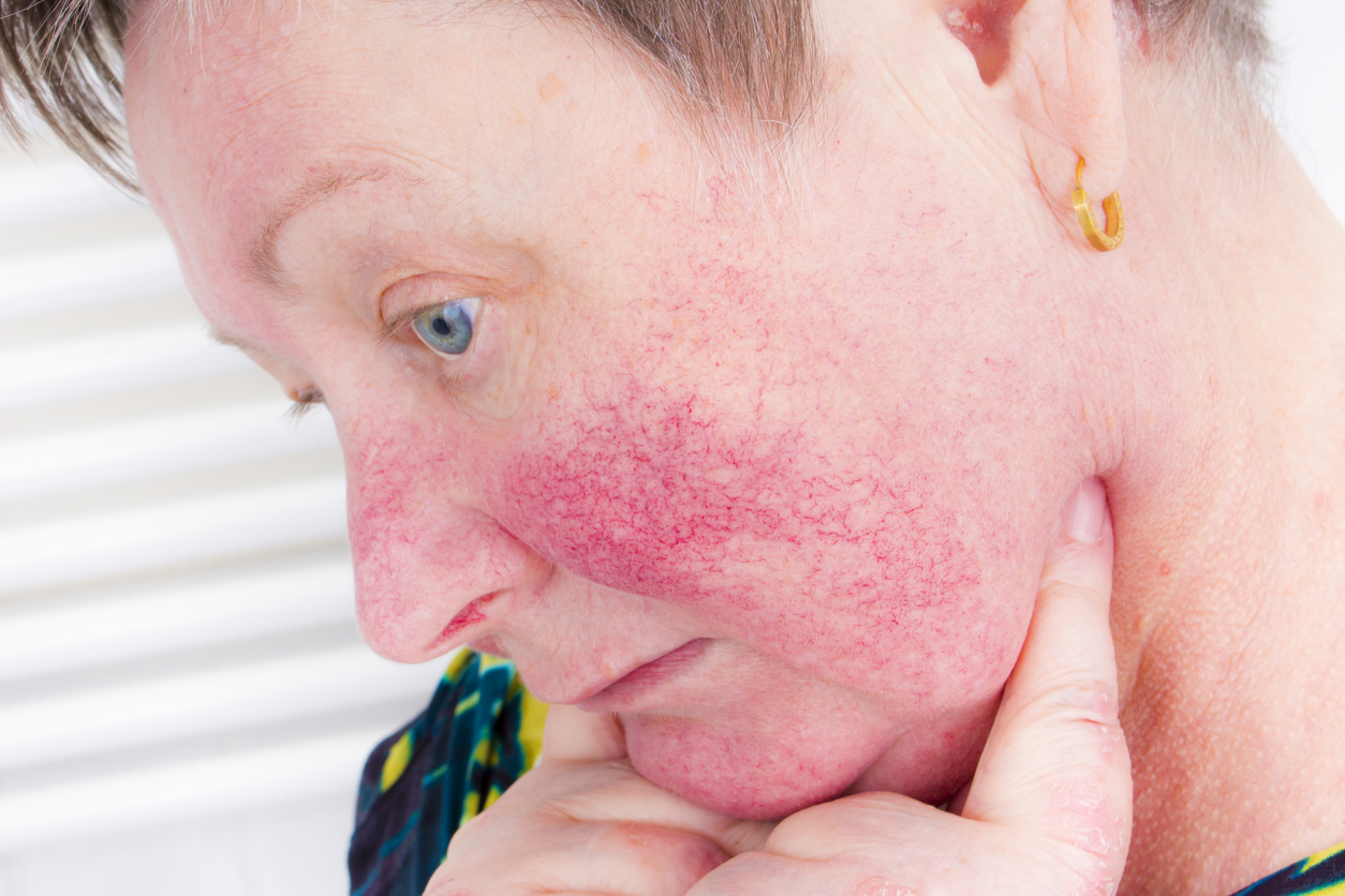 steroid rosacea